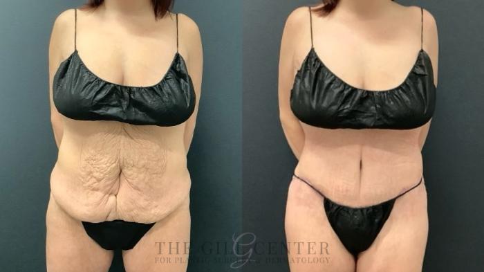 Tummy Tuck Case 654 Before & After Front | The Woodlands, TX | The Gill Center for Plastic Surgery and Dermatology