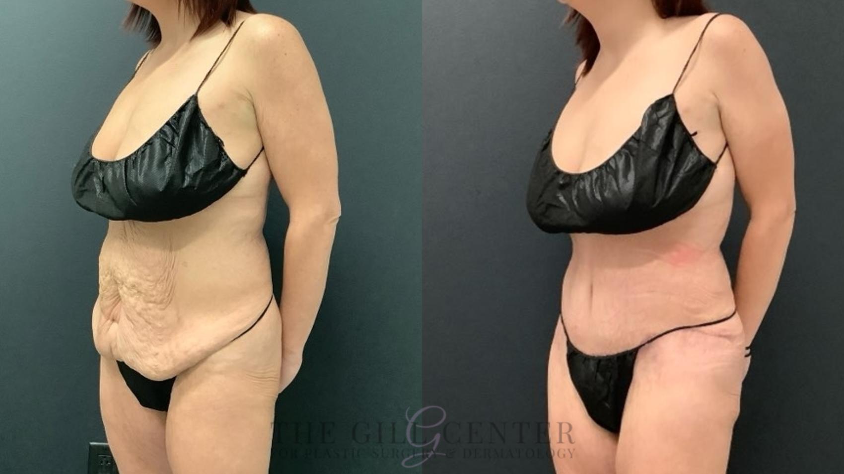Tummy Tuck Case 654 Before & After Left Oblique | The Woodlands, TX | The Gill Center for Plastic Surgery and Dermatology