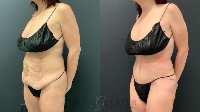 Tummy Tuck Case 654 Before & After Left Oblique | The Woodlands, TX | The Gill Center for Plastic Surgery and Dermatology