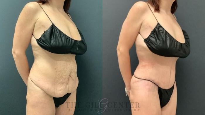 Tummy Tuck Case 654 Before & After Right Oblique | The Woodlands, TX | The Gill Center for Plastic Surgery and Dermatology
