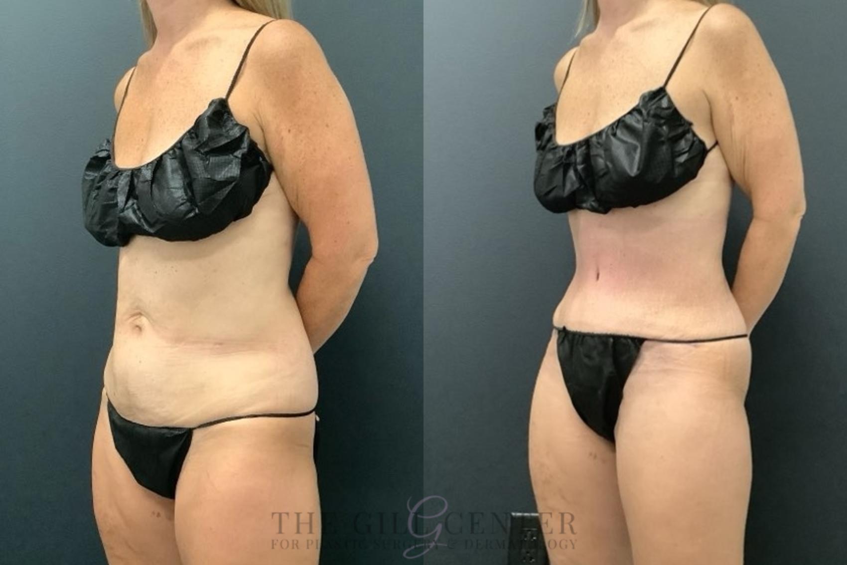 Tummy Tuck Case 666 Before & After Left Side | The Woodlands, TX | The Gill Center for Plastic Surgery and Dermatology