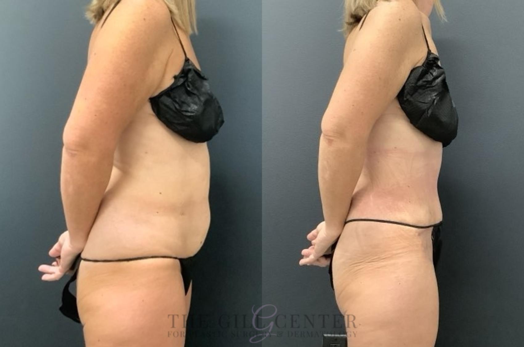 Tummy Tuck Case 666 Before & After Right Side | The Woodlands, TX | The Gill Center for Plastic Surgery and Dermatology