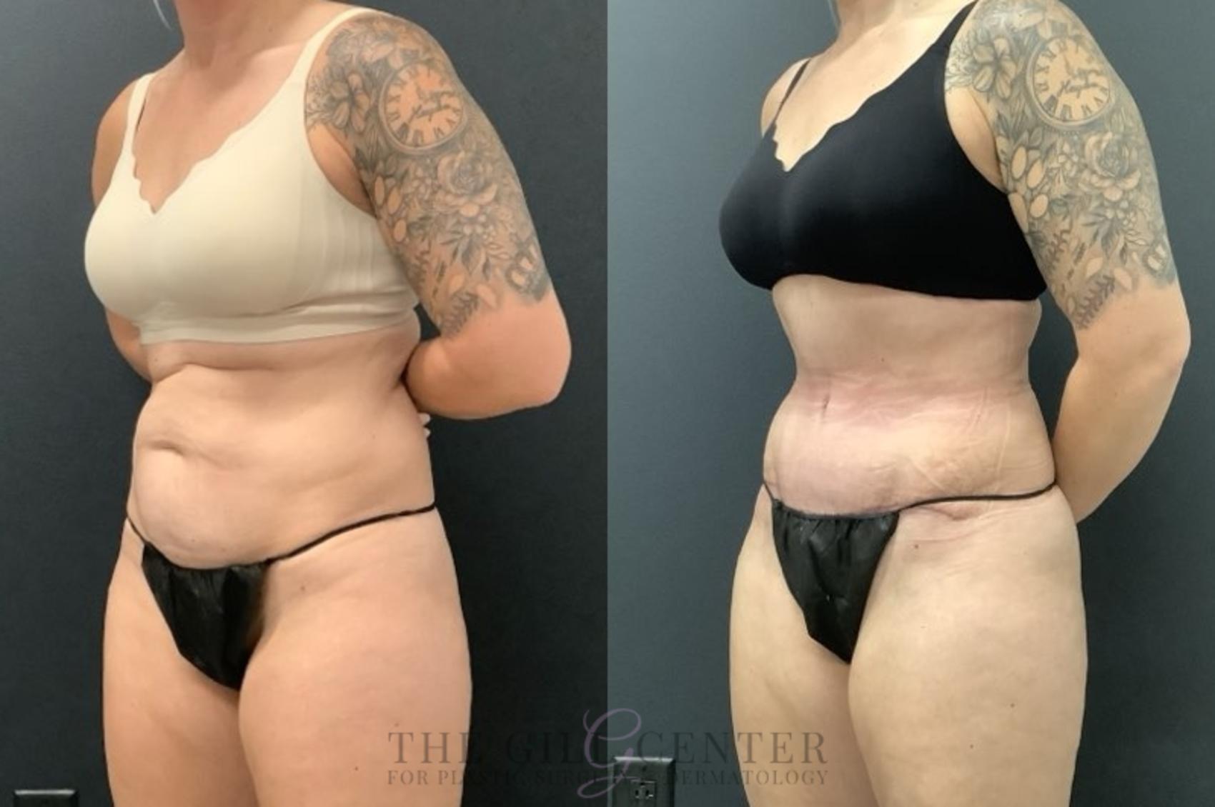 Tummy Tuck Case 667 Before & After Left Side | The Woodlands, TX | The Gill Center for Plastic Surgery and Dermatology
