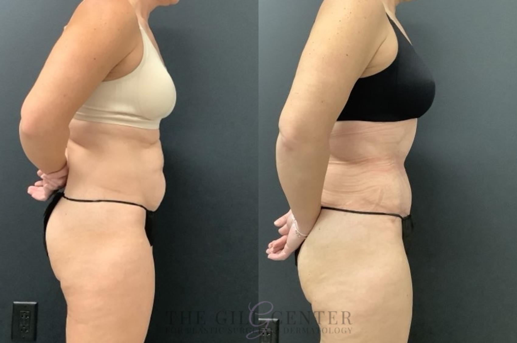 Tummy Tuck Case 667 Before & After Right Side | The Woodlands, TX | The Gill Center for Plastic Surgery and Dermatology