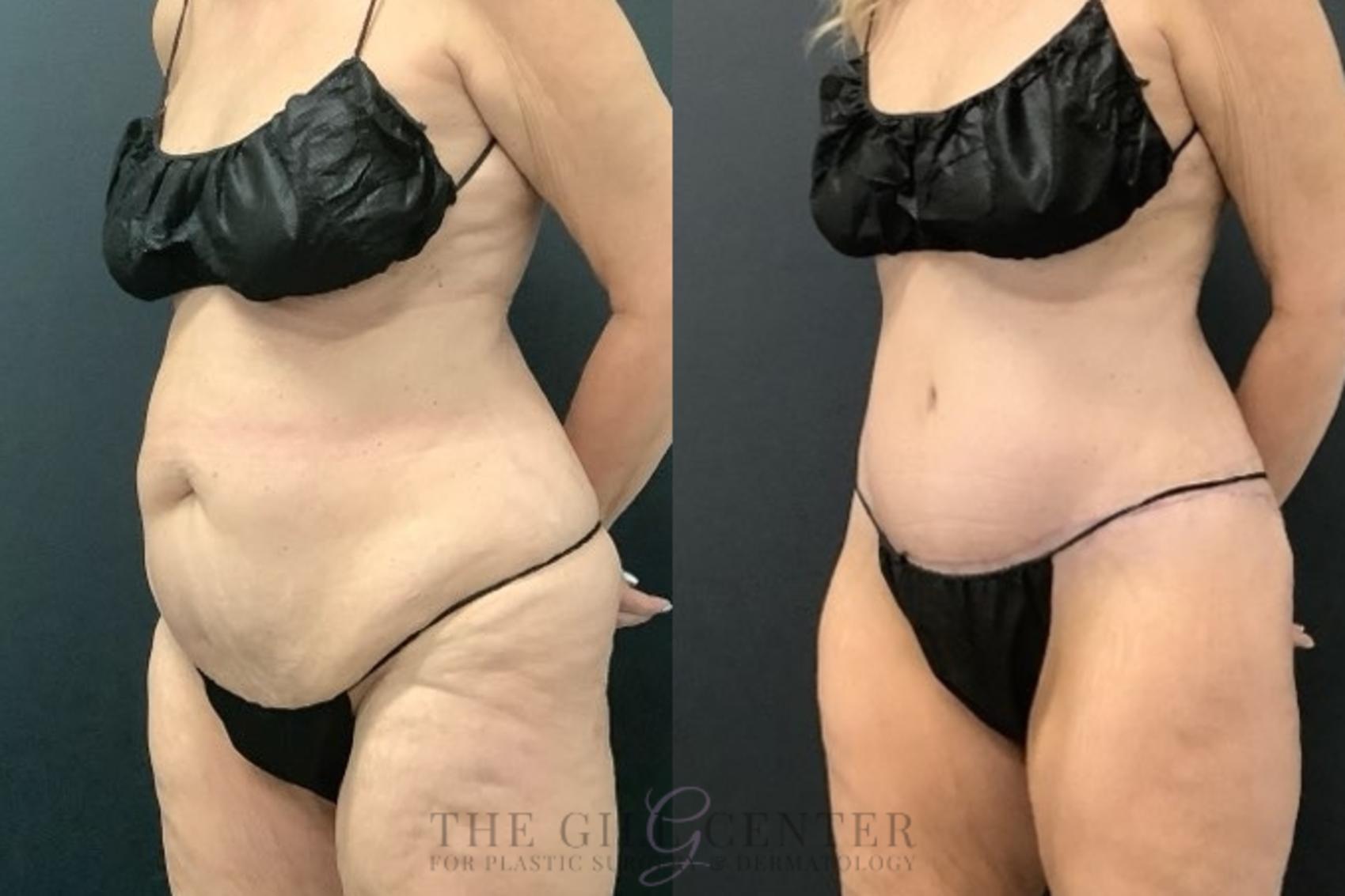 Tummy Tuck Case 671 Before & After Left Oblique | The Woodlands, TX | The Gill Center for Plastic Surgery and Dermatology