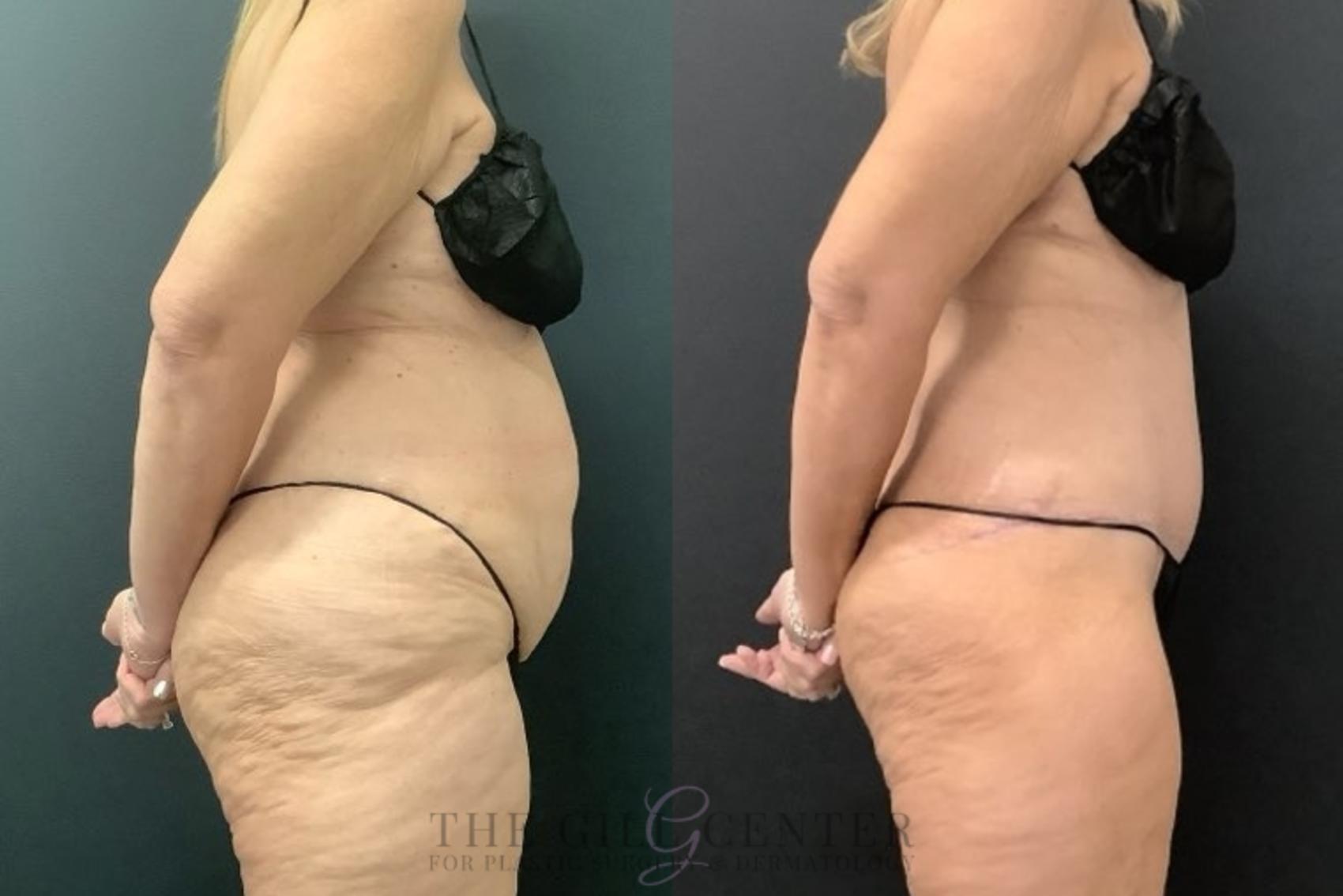 Tummy Tuck Case 671 Before & After Right Side | The Woodlands, TX | The Gill Center for Plastic Surgery and Dermatology