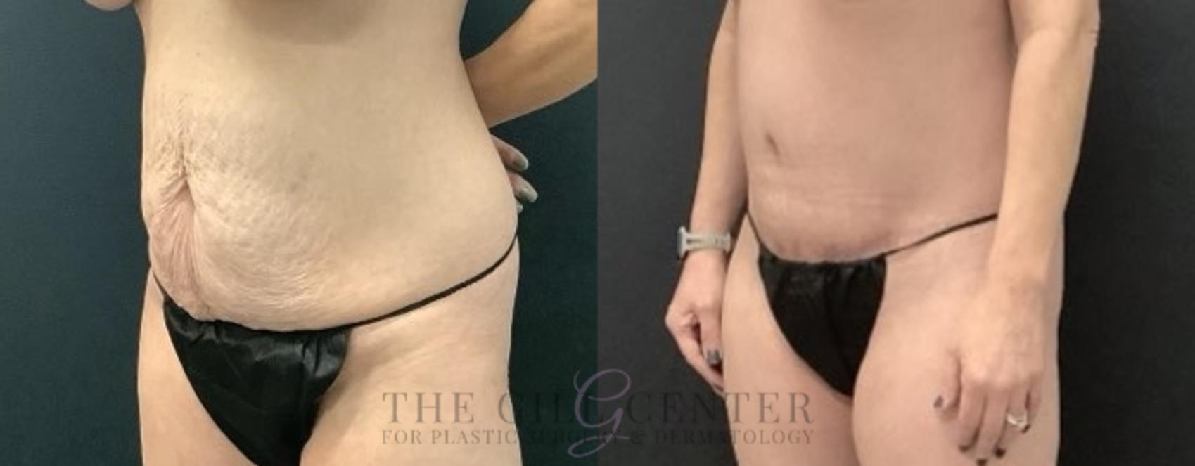 Tummy Tuck Case 673 Before & After Left Side | The Woodlands, TX | The Gill Center for Plastic Surgery and Dermatology