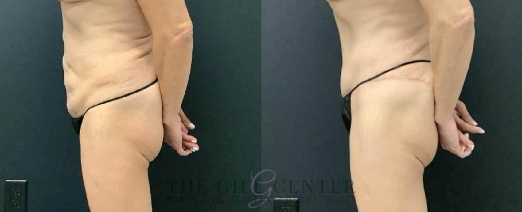 Tummy Tuck Case 674 Before & After Left Side | The Woodlands, TX | The Gill Center for Plastic Surgery and Dermatology