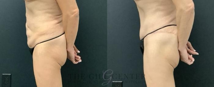 Tummy Tuck Case 674 Before & After Left Side | The Woodlands, TX | The Gill Center for Plastic Surgery and Dermatology