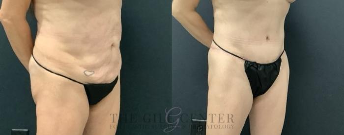 Tummy Tuck Case 674 Before & After Right Oblique | The Woodlands, TX | The Gill Center for Plastic Surgery and Dermatology