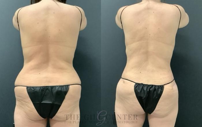 Tummy Tuck Case 683 Before & After Back | The Woodlands, TX | The Gill Center for Plastic Surgery and Dermatology