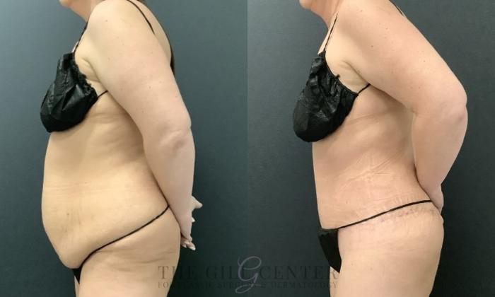 Tummy Tuck Case 683 Before & After Left Side | The Woodlands, TX | The Gill Center for Plastic Surgery and Dermatology