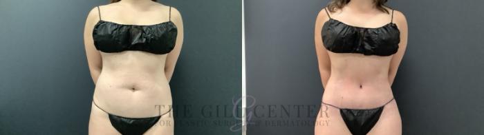 Tummy Tuck Case 690 Before & After Front | The Woodlands, TX | The Gill Center for Plastic Surgery and Dermatology
