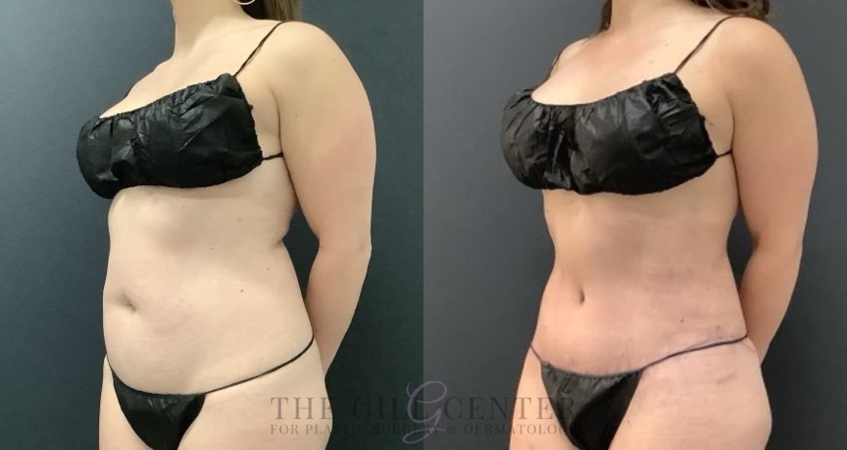 Tummy Tuck Case 690 Before & After Left Side | The Woodlands, TX | The Gill Center for Plastic Surgery and Dermatology