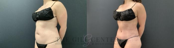 Tummy Tuck Case 690 Before & After Left Side | The Woodlands, TX | The Gill Center for Plastic Surgery and Dermatology