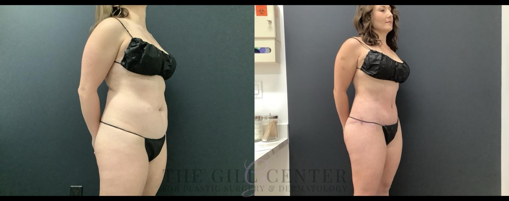 Tummy Tuck Case 690 Before & After Right Side | The Woodlands, TX | The Gill Center for Plastic Surgery and Dermatology