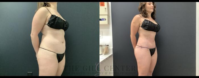 Tummy Tuck Case 690 Before & After Right Side | The Woodlands, TX | The Gill Center for Plastic Surgery and Dermatology