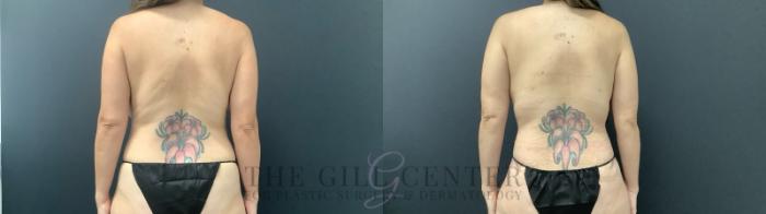 Tummy Tuck Case 691 Before & After Back | The Woodlands, TX | The Gill Center for Plastic Surgery and Dermatology