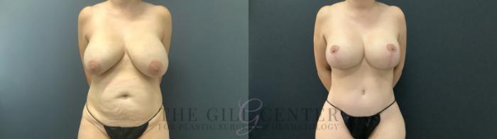 Tummy Tuck Case 691 Before & After Front | The Woodlands, TX | The Gill Center for Plastic Surgery and Dermatology