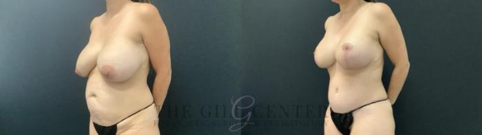 Tummy Tuck Case 691 Before & After Left Side | The Woodlands, TX | The Gill Center for Plastic Surgery and Dermatology