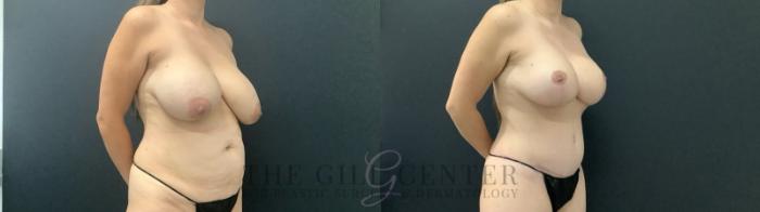 Tummy Tuck Case 691 Before & After Right Side | The Woodlands, TX | The Gill Center for Plastic Surgery and Dermatology