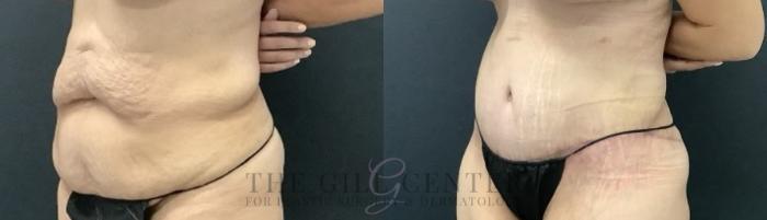 Tummy Tuck Case 696 Before & After Left Side | The Woodlands, TX | The Gill Center for Plastic Surgery and Dermatology