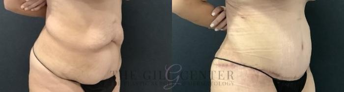 Tummy Tuck Case 696 Before & After Right Side | The Woodlands, TX | The Gill Center for Plastic Surgery and Dermatology