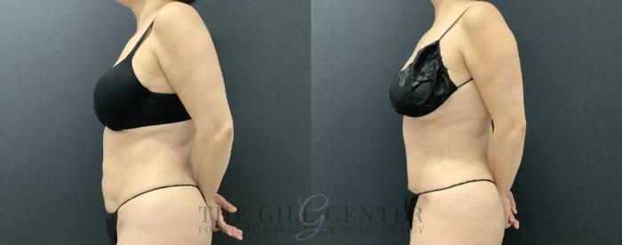 Tummy Tuck Case 697 Before & After Left Oblique | The Woodlands, TX | The Gill Center for Plastic Surgery and Dermatology