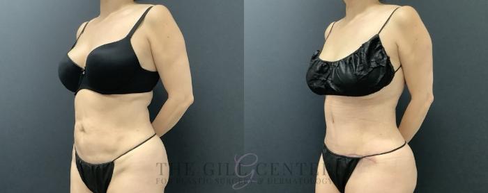Tummy Tuck Case 697 Before & After Left Side | The Woodlands, TX | The Gill Center for Plastic Surgery and Dermatology