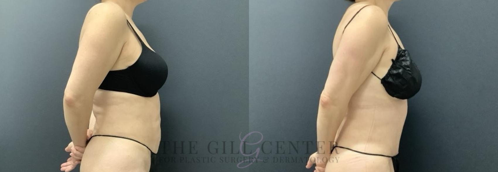 Tummy Tuck Case 697 Before & After Right Oblique | The Woodlands, TX | The Gill Center for Plastic Surgery and Dermatology