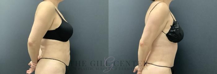 Tummy Tuck Case 697 Before & After Right Oblique | The Woodlands, TX | The Gill Center for Plastic Surgery and Dermatology