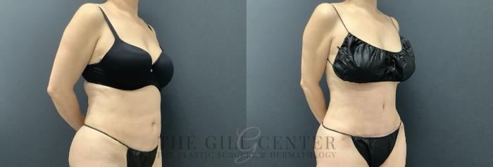 Tummy Tuck Case 697 Before & After Right Side | The Woodlands, TX | The Gill Center for Plastic Surgery and Dermatology