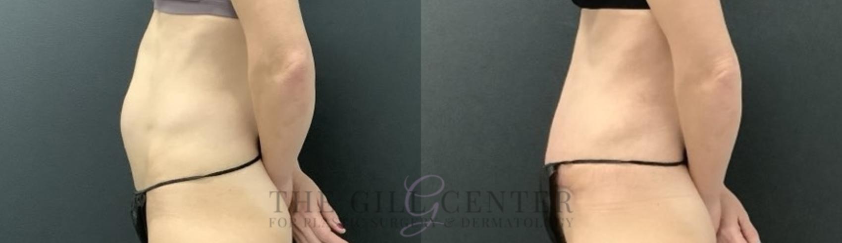 Tummy Tuck Case 698 Before & After Left Oblique | The Woodlands, TX | The Gill Center for Plastic Surgery and Dermatology