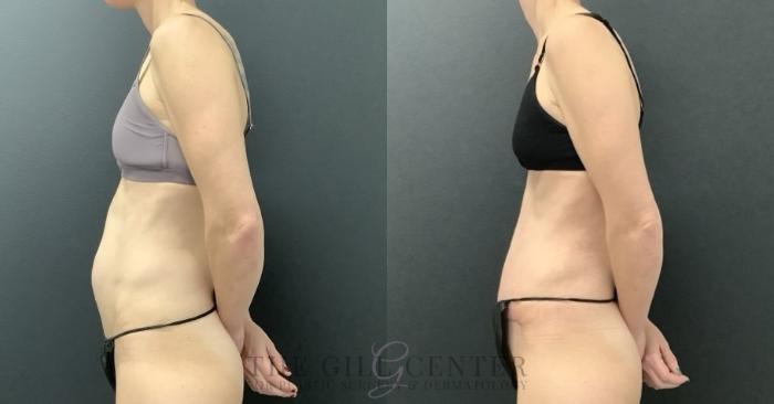 Tummy Tuck Case 698 Before & After Left Oblique | The Woodlands, TX | The Gill Center for Plastic Surgery and Dermatology