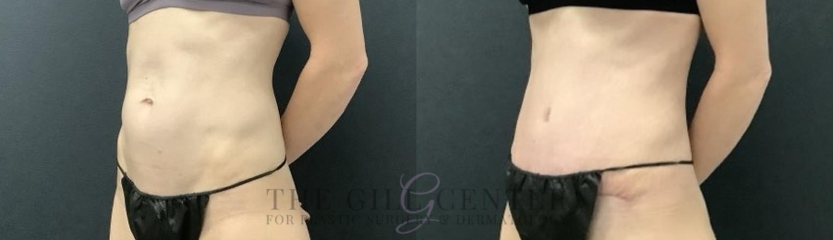 Tummy Tuck Case 698 Before & After Left Side | The Woodlands, TX | The Gill Center for Plastic Surgery and Dermatology