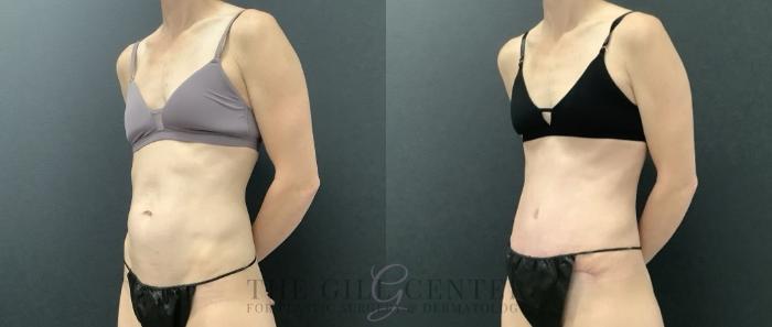 Tummy Tuck Case 698 Before & After Left Side | The Woodlands, TX | The Gill Center for Plastic Surgery and Dermatology