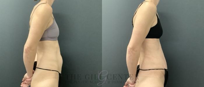 Tummy Tuck Case 698 Before & After Right Oblique | The Woodlands, TX | The Gill Center for Plastic Surgery and Dermatology