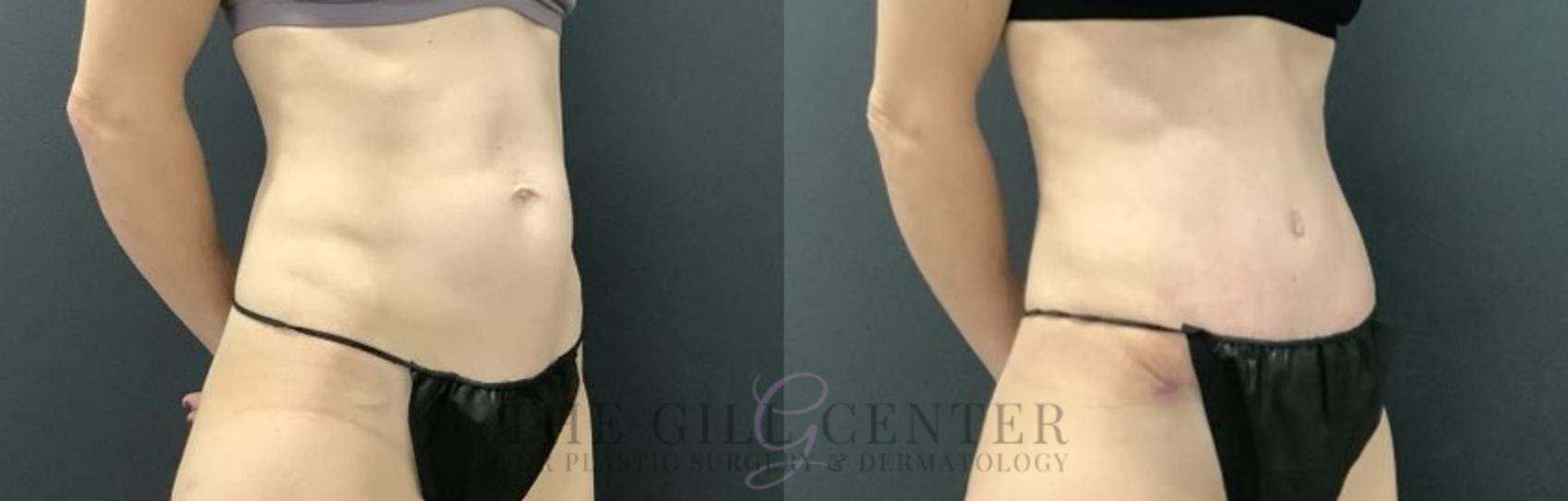 Tummy Tuck Case 698 Before & After Right Side | The Woodlands, TX | The Gill Center for Plastic Surgery and Dermatology