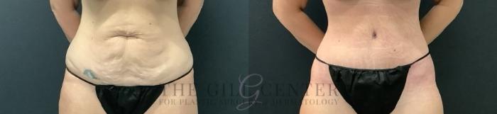 Tummy Tuck Case 703 Before & After Front | The Woodlands, TX | The Gill Center for Plastic Surgery and Dermatology