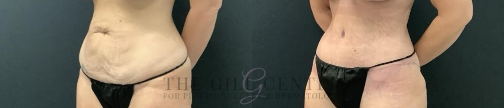 Tummy Tuck Case 703 Before & After Left Side | The Woodlands, TX | The Gill Center for Plastic Surgery and Dermatology
