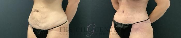 Tummy Tuck Case 703 Before & After Left Side | The Woodlands, TX | The Gill Center for Plastic Surgery and Dermatology