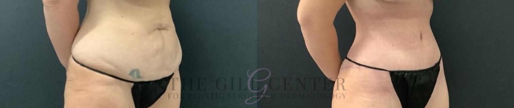 Tummy Tuck Case 703 Before & After Right Side | The Woodlands, TX | The Gill Center for Plastic Surgery and Dermatology