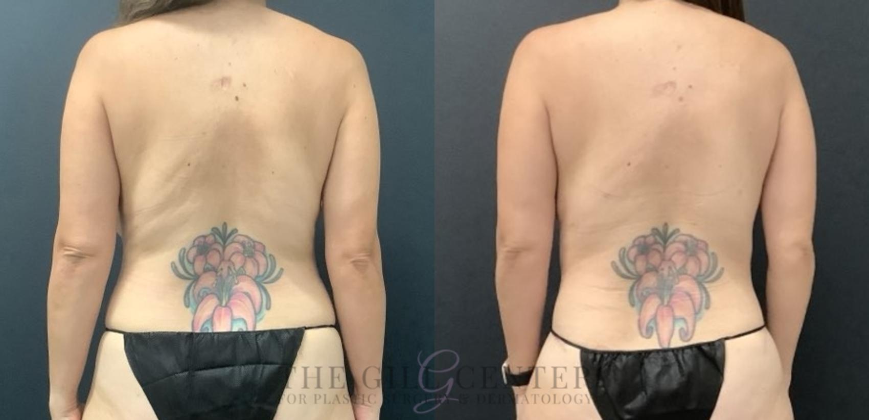 Tummy Tuck Case 715 Before & After Back | The Woodlands, TX | The Gill Center for Plastic Surgery and Dermatology