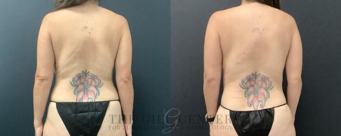 Liposuction Case 715 Before & After Back | The Woodlands, TX | The Gill Center for Plastic Surgery and Dermatology