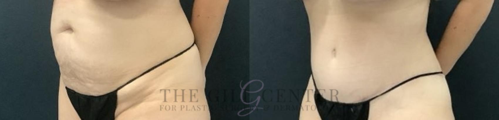 Tummy Tuck Case 715 Before & After Left Side | The Woodlands, TX | The Gill Center for Plastic Surgery and Dermatology