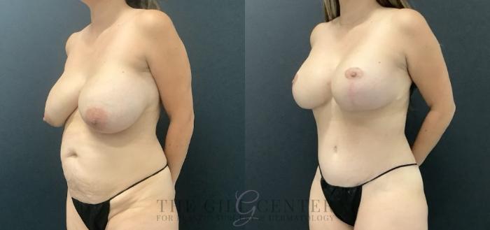 Liposuction Case 715 Before & After Left Side | The Woodlands, TX | The Gill Center for Plastic Surgery and Dermatology