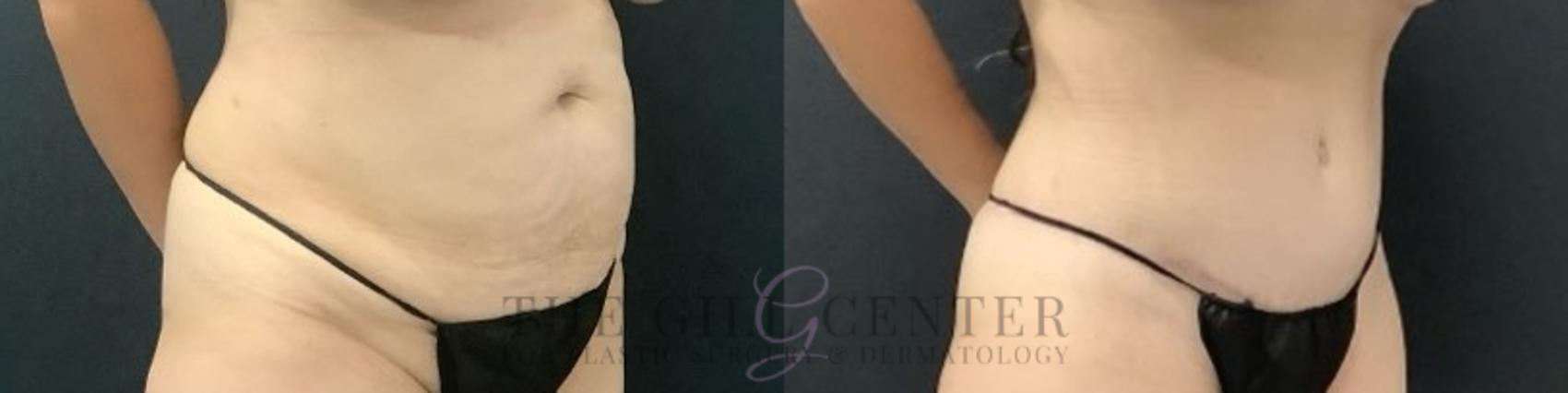 Tummy Tuck Case 715 Before & After Right Side | The Woodlands, TX | The Gill Center for Plastic Surgery and Dermatology