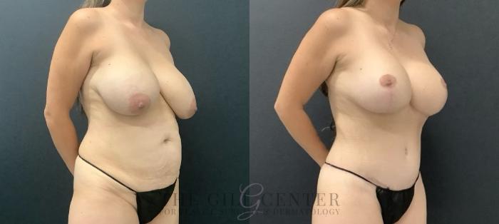 Liposuction Case 715 Before & After Right Side | The Woodlands, TX | The Gill Center for Plastic Surgery and Dermatology