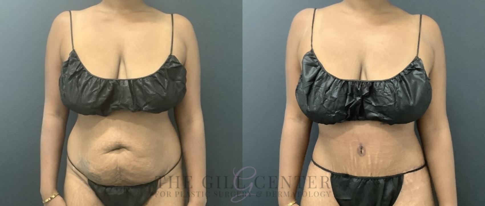 Tummy Tuck Case 721 Before & After Front | The Woodlands, TX | The Gill Center for Plastic Surgery and Dermatology