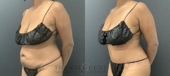 Tummy Tuck Case 721 Before & After Left Oblique | The Woodlands, TX | The Gill Center for Plastic Surgery and Dermatology